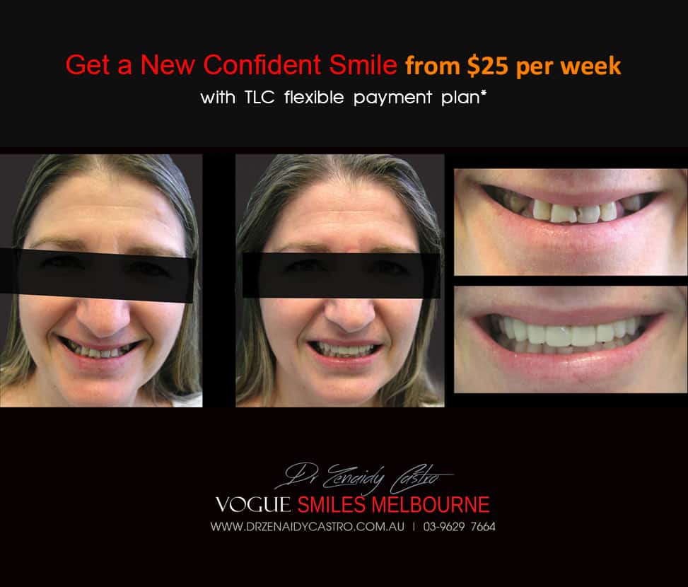 Affordable-Cheap-Cosmetic-Smile-Makeover