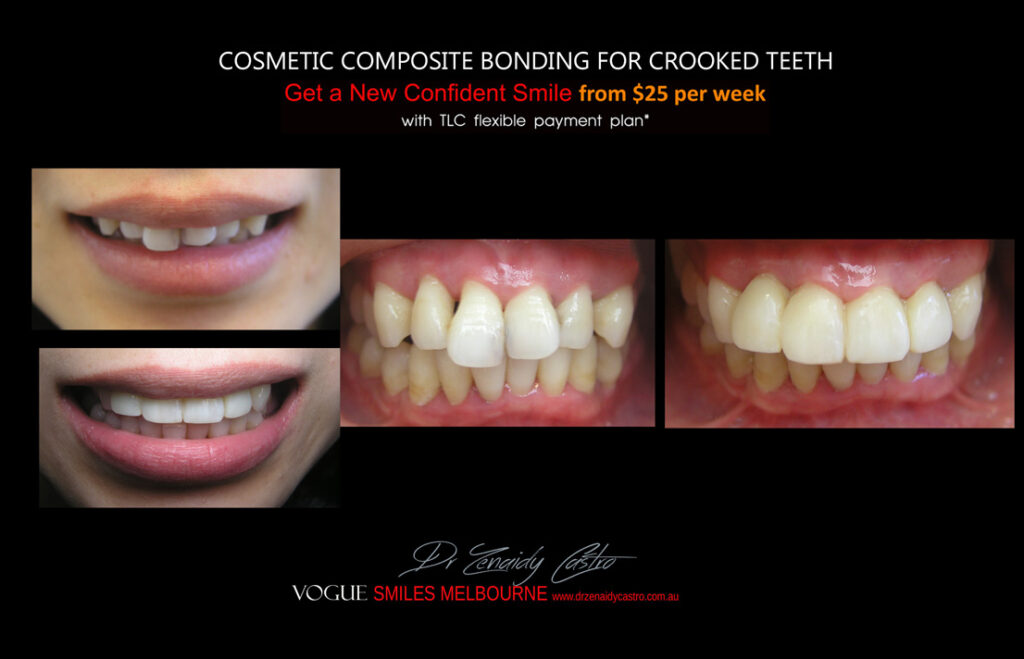 Affordable-Cheap-Cosmetic-Smile-Makeover