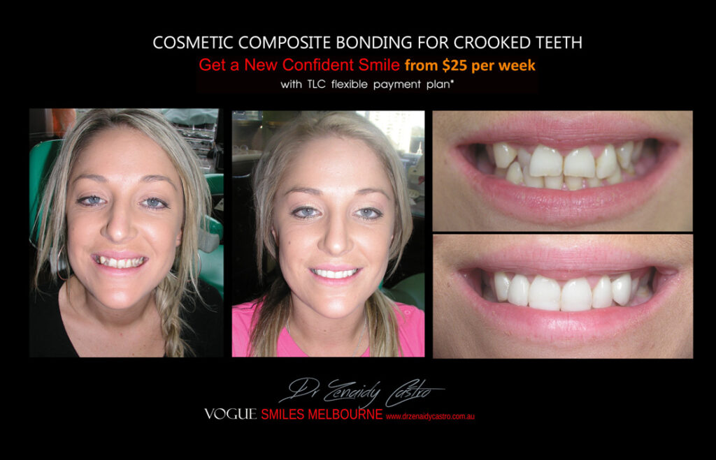 Affordable-Cheap-Cosmetic-Smile-Makeover