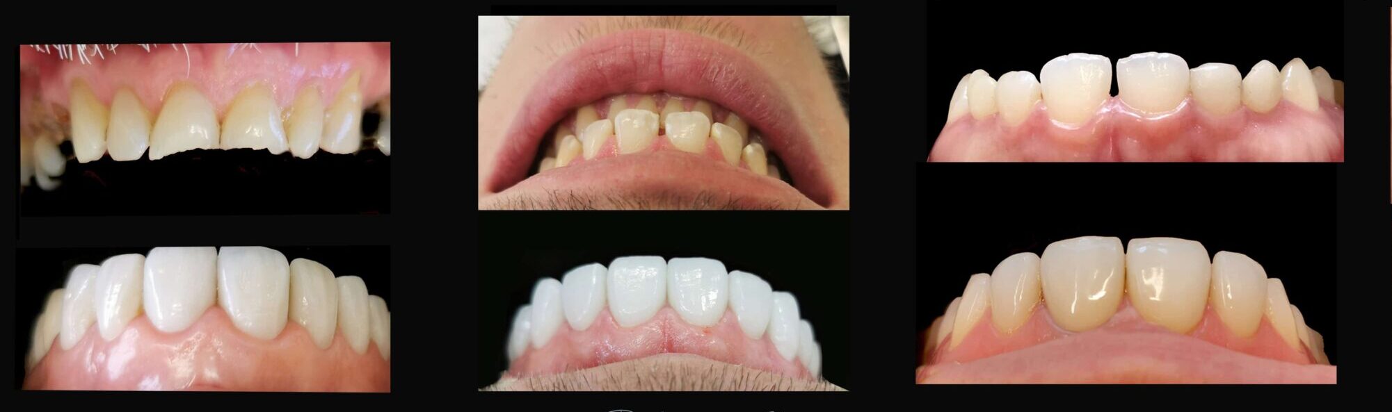 Porcelain Dental Veneers in Noble Park North, Melbourne CBD, Dandenong,  Springvale South, Glen Waverley, Mulgrave, Jackson Road, Mount Waverley, Clayton, Keysborough