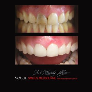 Cover Tetracycline Stains Using Porcelain Veneers or Crown, Cheapest Cosmetic Dentist Near Me for Smile Makeovers, Cosmetic Dentistry in Noble Park North, Affordable Smile Makeover Dentistry in Noble Park North. General Dentist Noble Park North- Best Dentist in Noble Park North - Best Dental Clinic in Noble Park North, Best Cosmetic Dentist in Noble Park North. Serving surrounding suburbs Dandenong North, Mulgrave, Springvale, Springvale South, Noble Park, Rowville, Wheelers Hill, Keysborough, and Endeavour Hills, Mulgrave, Glen Waverly