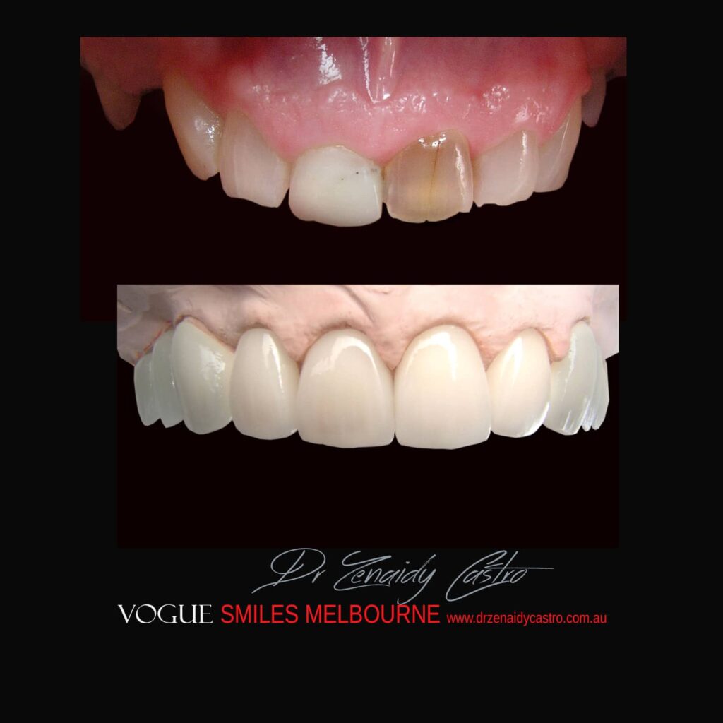 BLACK-TOOTH-DEAD-FRONT-TOOTH