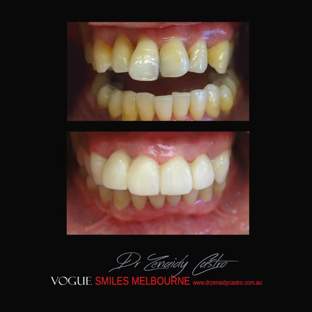 BLACK-TOOTH-DEAD-FRONT-TOOTH