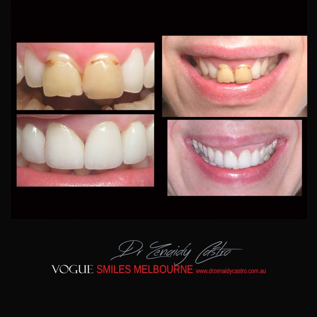 BLACK-TOOTH-DEAD-FRONT-TOOTH