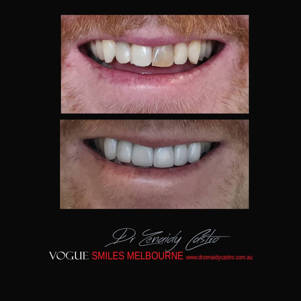 BLACK-TOOTH-DEAD-FRONT-TOOTH