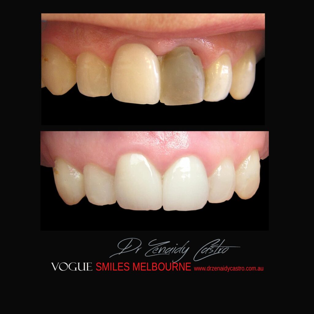 BLACK-TOOTH-DEAD-FRONT-TOOTH
