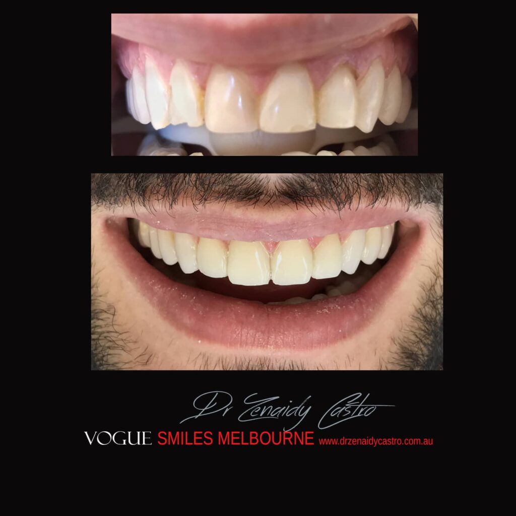 BLACK-TOOTH-DEAD-FRONT-TOOTH