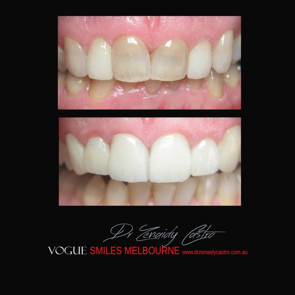 BLACK-TOOTH-DEAD-FRONT-TOOTH