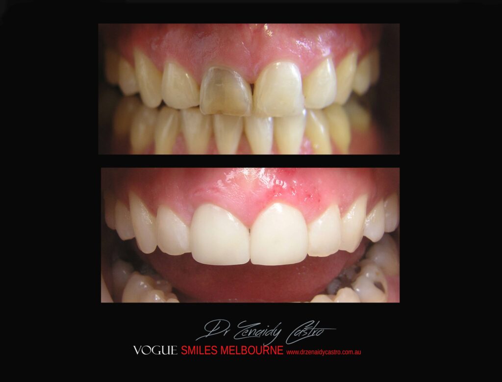 BLACK-TOOTH-DEAD-FRONT-TOOTH