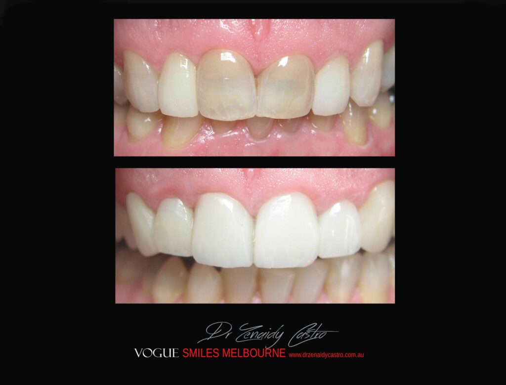 BLACK-TOOTH-DEAD-FRONT-TOOTH