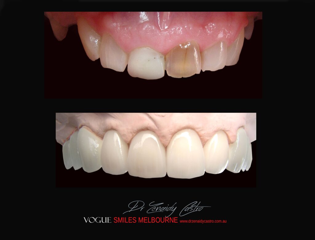 BLACK-TOOTH-DEAD-FRONT-TOOTH