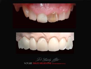 Cover Tetracycline Stains Using Porcelain Veneers