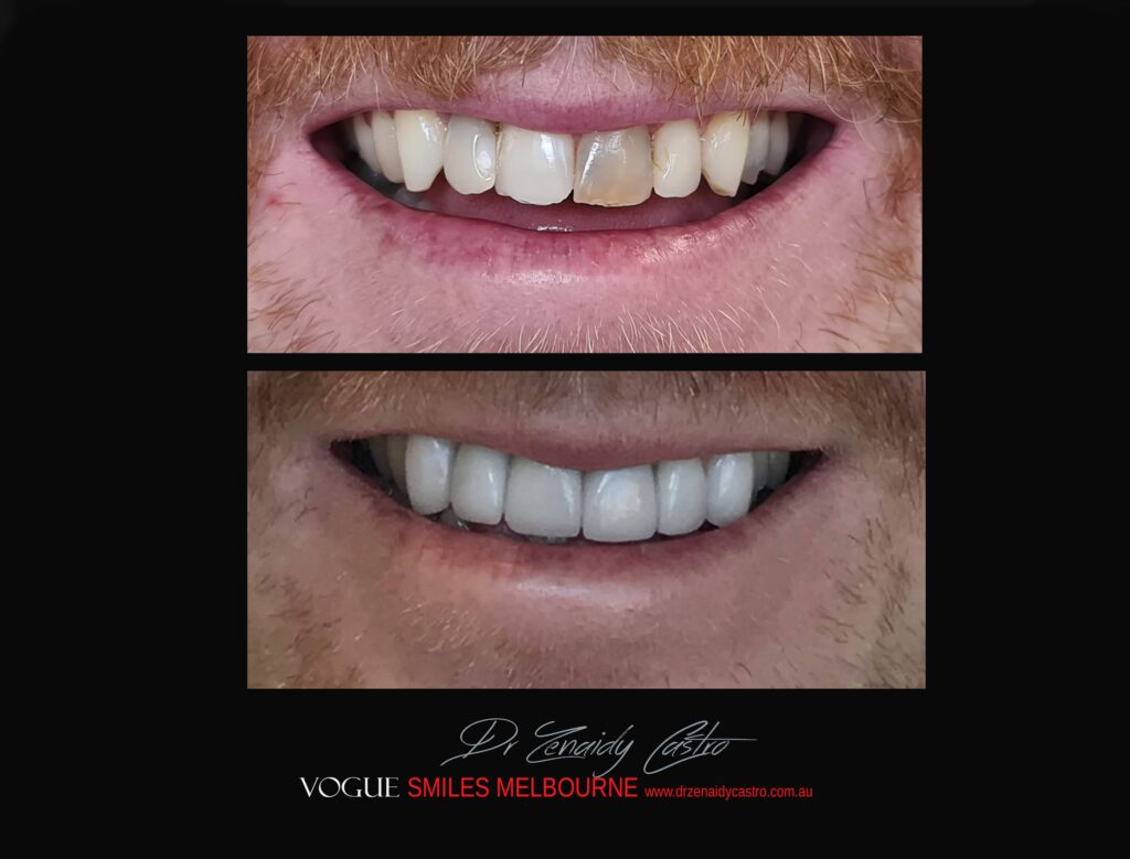 BLACK-TOOTH-DEAD-FRONT-TOOTH