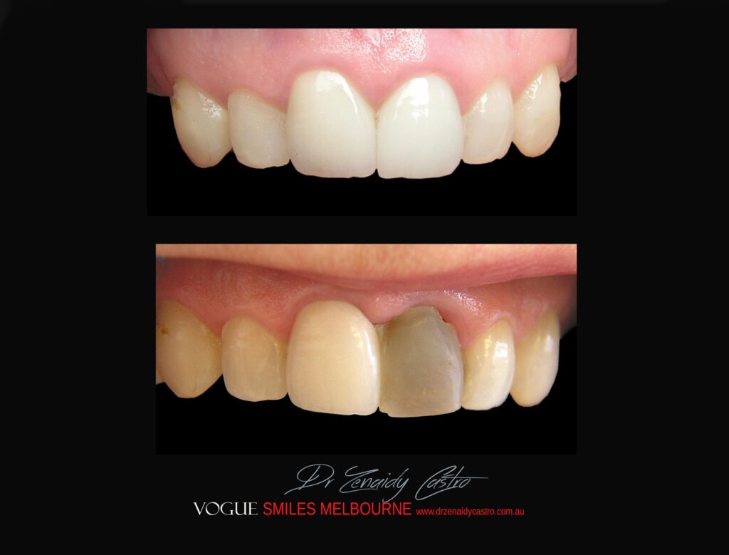 BLACK-TOOTH-DEAD-FRONT-TOOTH