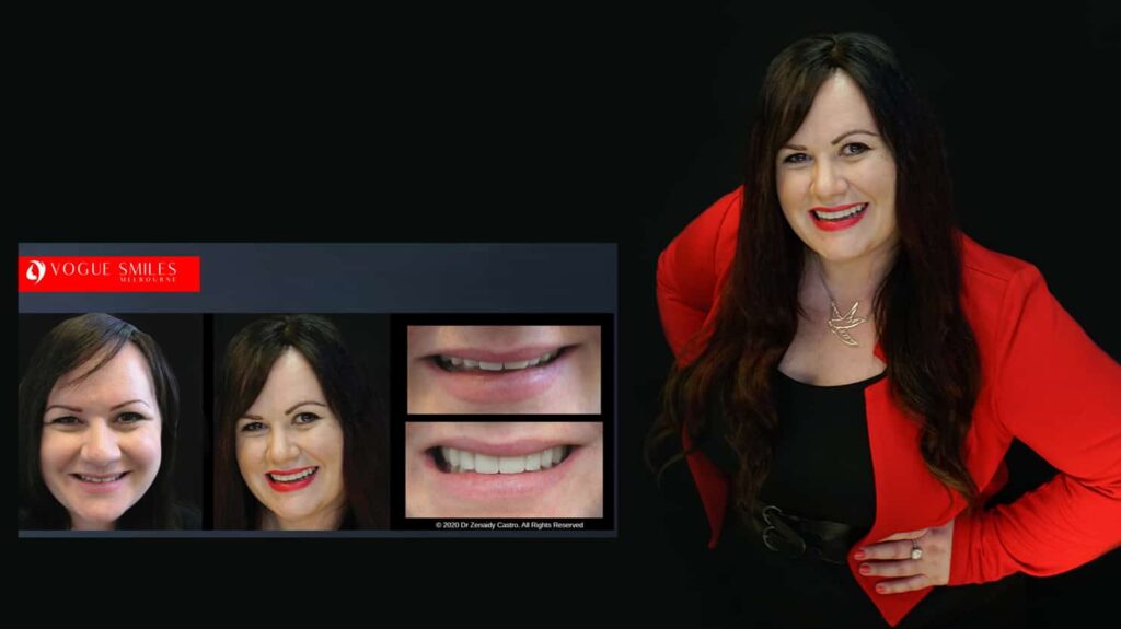 Gorgeous Smiles with Porcelain Veneers in Melbourne