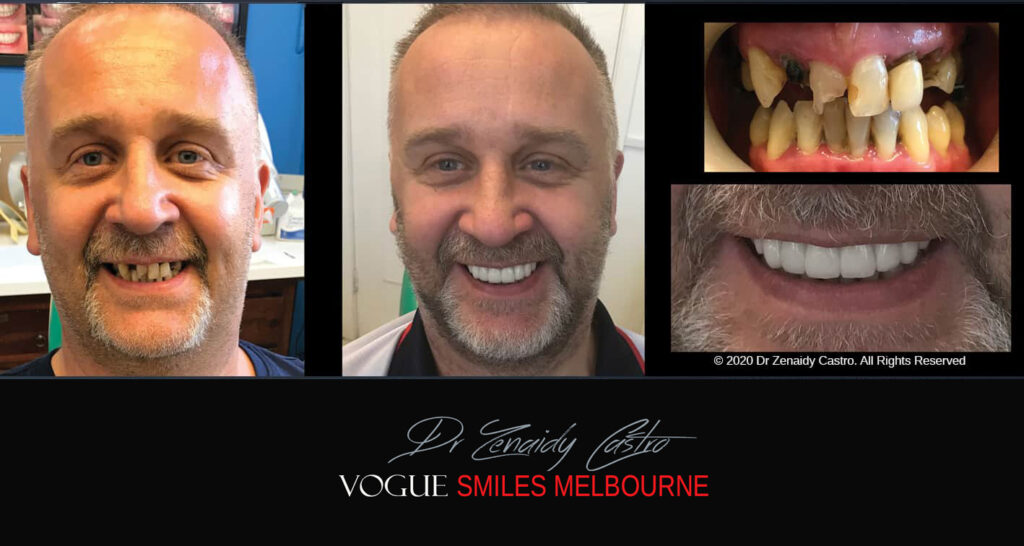 Smile Makeover near Glen Waverley area, Smile Makeover Cosmetic Dentist in Glen Waverley