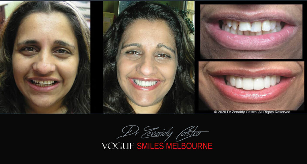 Smile Makeover near Glen Waverley area, Smile Makeover Cosmetic Dentist in Glen Waverley