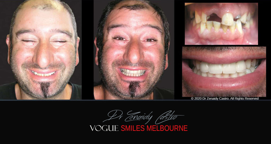 Smile Makeover near Glen Waverley area, Smile Makeover Cosmetic Dentist in Glen Waverley