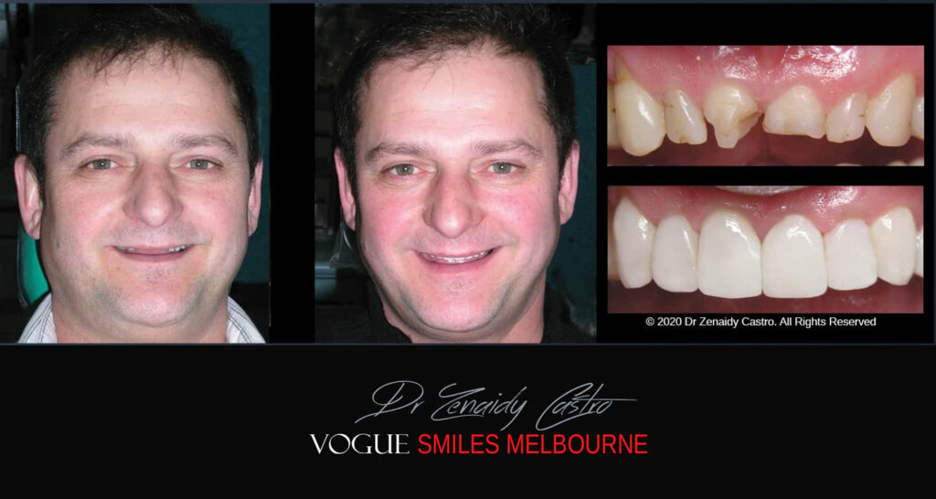 Smile Makeover near Glen Waverley area, Smile Makeover Cosmetic Dentist in Glen Waverley