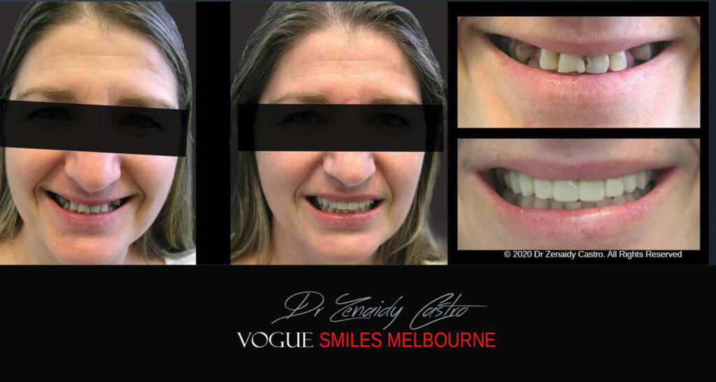 Smile Makeover near Glen Waverley area, Smile Makeover Cosmetic Dentist in Glen Waverley