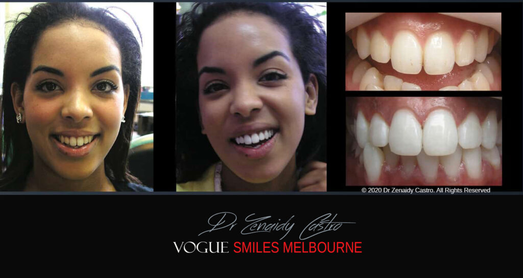 Smile Makeover near Glen Waverley area, Smile Makeover Cosmetic Dentist in Glen Waverley