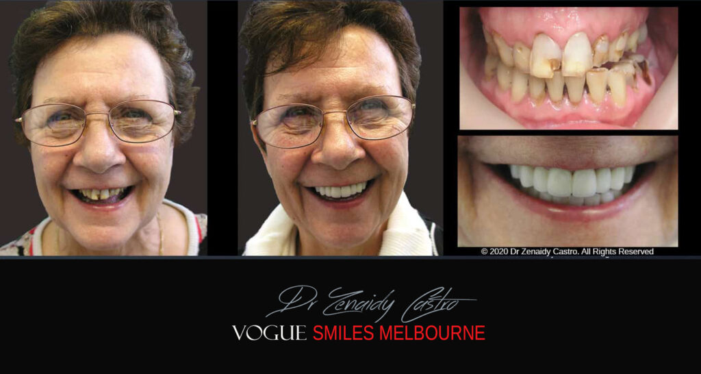 Smile Makeover near Glen Waverley area, Smile Makeover Cosmetic Dentist in Glen Waverley