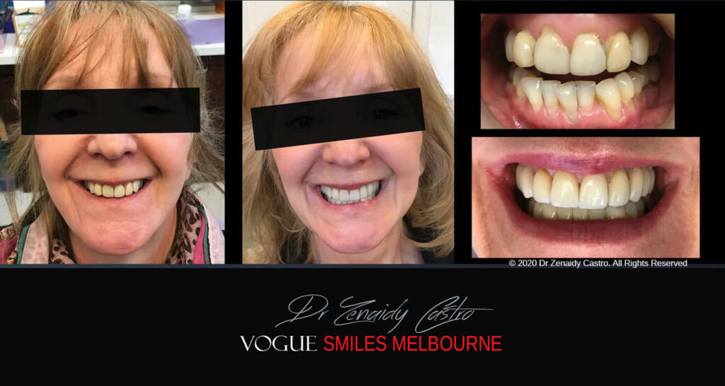 Smile Makeover near Glen Waverley area, Smile Makeover Cosmetic Dentist in Glen Waverley