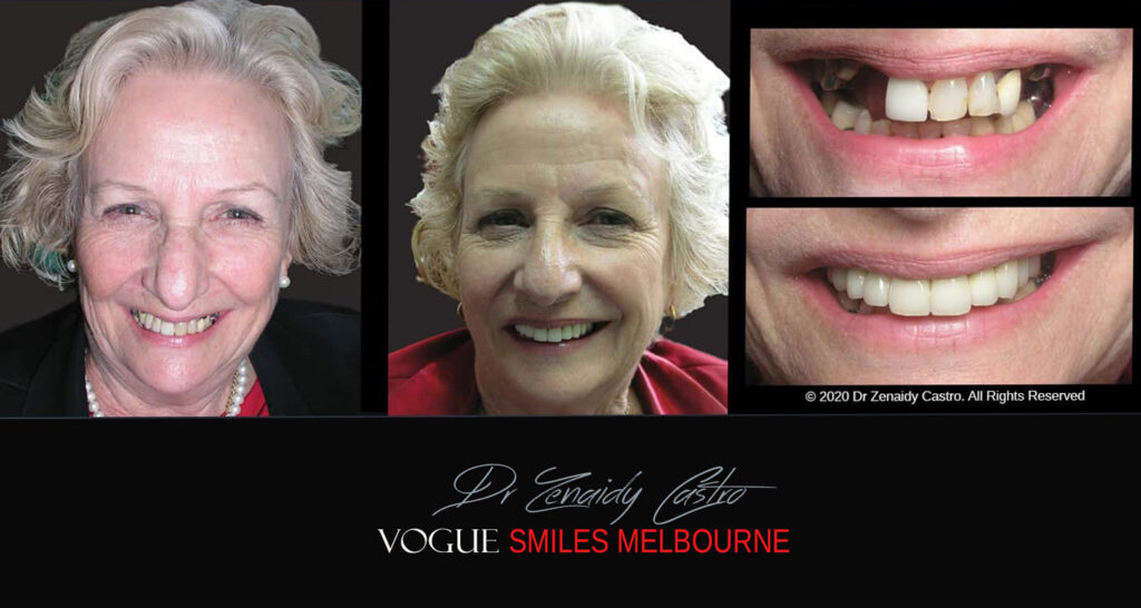 Smile Makeover near Glen Waverley area, Smile Makeover Cosmetic Dentist in Glen Waverley