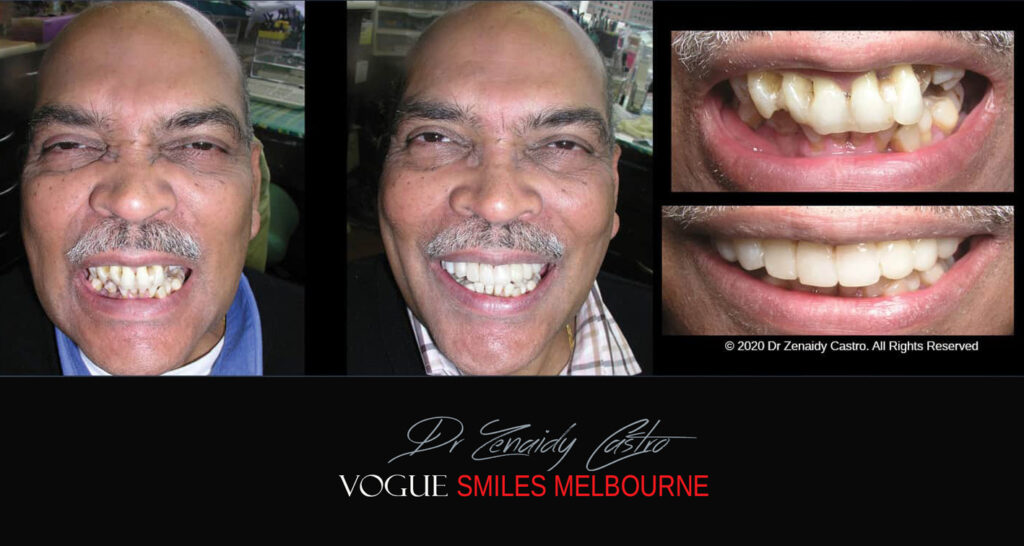 Smile Makeover near Glen Waverley area, Smile Makeover Cosmetic Dentist in Glen Waverley