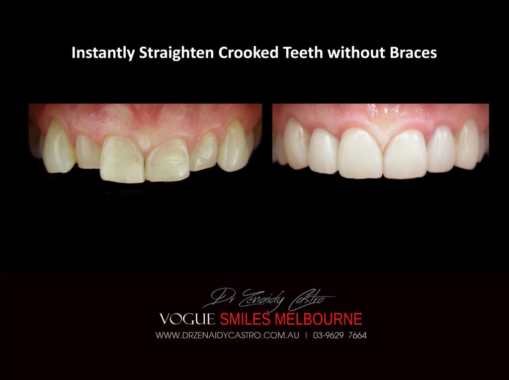 Fix Crooked Teeth - Instant Teeth Straightening with Porcelain Veneers -Family Cosmetic Dental Practice - Noble Park North Dentist