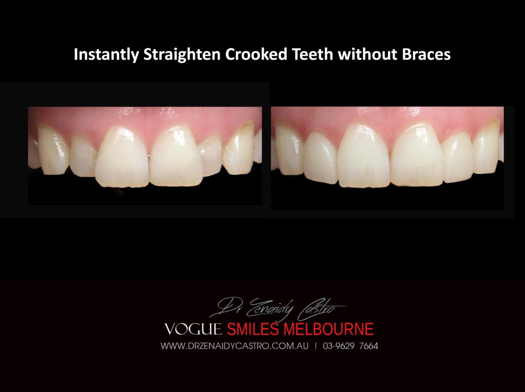 Fix Crooked Teeth - Instant Teeth Straightening with Porcelain Veneers -Family Cosmetic Dental Practice - Noble Park North Dentist