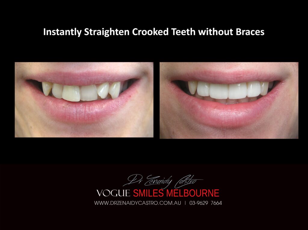 Fix Crooked Teeth - Instant Teeth Straightening with Porcelain Veneers -Family Cosmetic Dental Practice - Noble Park North Dentist
