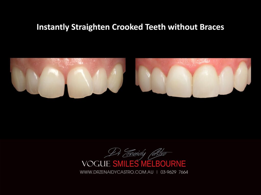 Fix Crooked Teeth - Instant Teeth Straightening with Porcelain Veneers -Family Cosmetic Dental Practice - Noble Park North Dentist