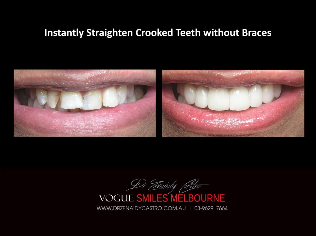Fix Crooked Teeth - Instant Teeth Straightening with Porcelain Veneers -Family Cosmetic Dental Practice - Noble Park North Dentist