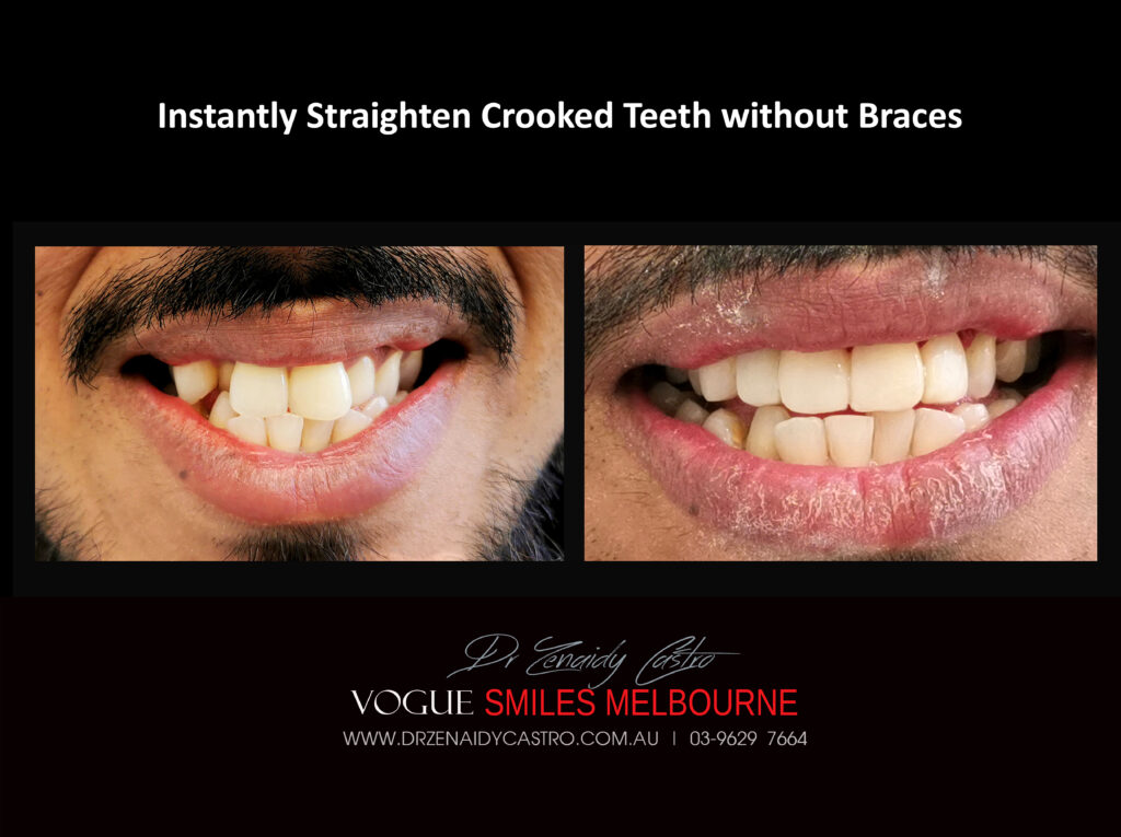 Fix Crooked Teeth - Instant Teeth Straightening with Porcelain Veneers -Family Cosmetic Dental Practice - Noble Park North Dentist