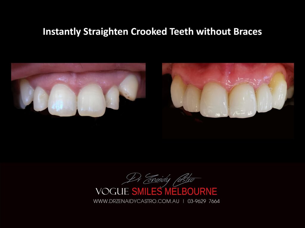 Fix Crooked Teeth - Instant Teeth Straightening with Porcelain Veneers -Family Cosmetic Dental Practice - Noble Park North Dentist