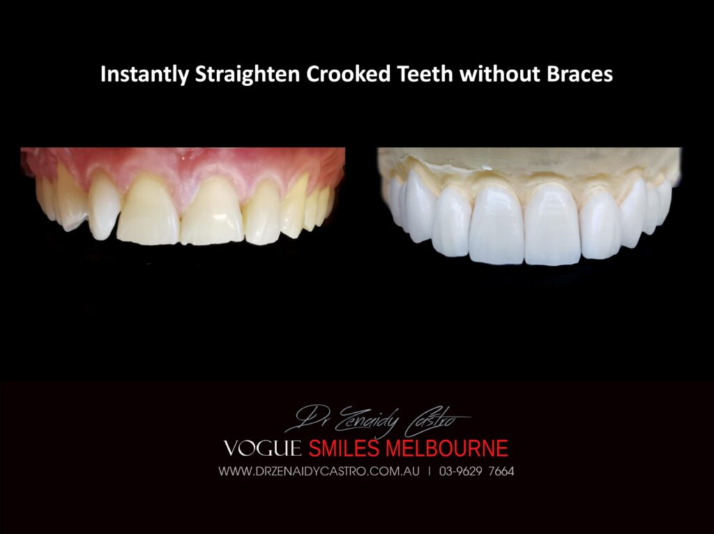 Fix Crooked Teeth - Instant Teeth Straightening with Porcelain Veneers -Family Cosmetic Dental Practice - Noble Park North Dentist