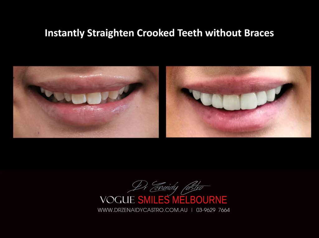 Fix Crooked Teeth - Instant Teeth Straightening with Porcelain Veneers -Family Cosmetic Dental Practice - Noble Park North Dentist