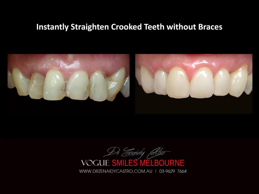 Fix Crooked Teeth - Instant Teeth Straightening with Porcelain Veneers -Family Cosmetic Dental Practice - Noble Park North Dentist