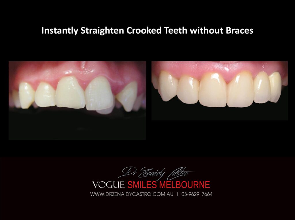 Fix Crooked Teeth - Instant Teeth Straightening with Porcelain Veneers -Family Cosmetic Dental Practice - Noble Park North Dentist