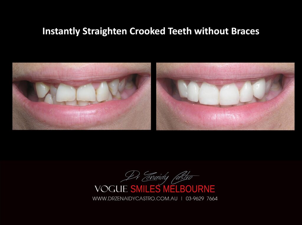 Fix Crooked Teeth - Instant Teeth Straightening with Porcelain Veneers -Family Cosmetic Dental Practice - Noble Park North Dentist
