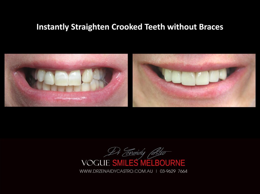 Fix Crooked Teeth - Instant Teeth Straightening with Porcelain Veneers -Family Cosmetic Dental Practice - Noble Park North Dentist