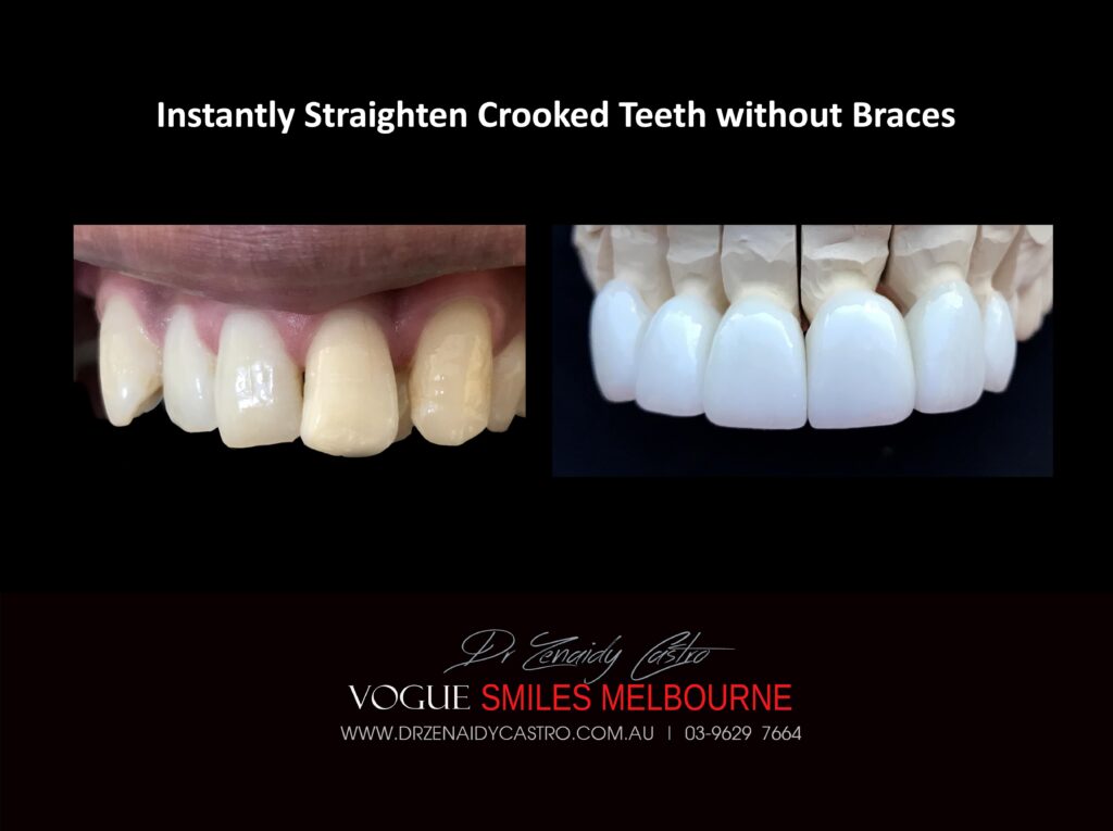 Fix Crooked Teeth - Instant Teeth Straightening with Porcelain Veneers -Family Cosmetic Dental Practice - Noble Park North Dentist