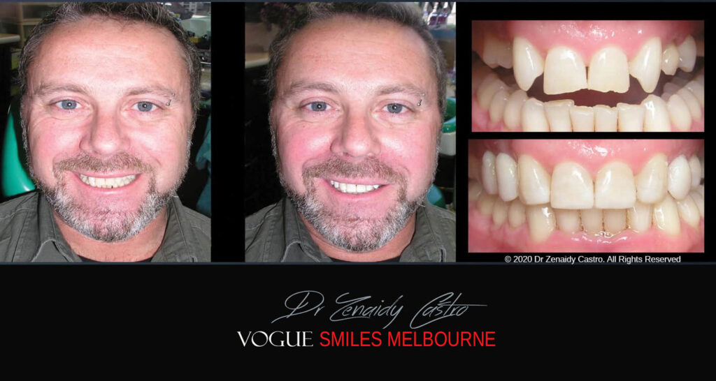 Composite Resin Veneers near Jackson Road Noble Park North - Dental bonding Composite Veneers in Jackson Road Noble Park North