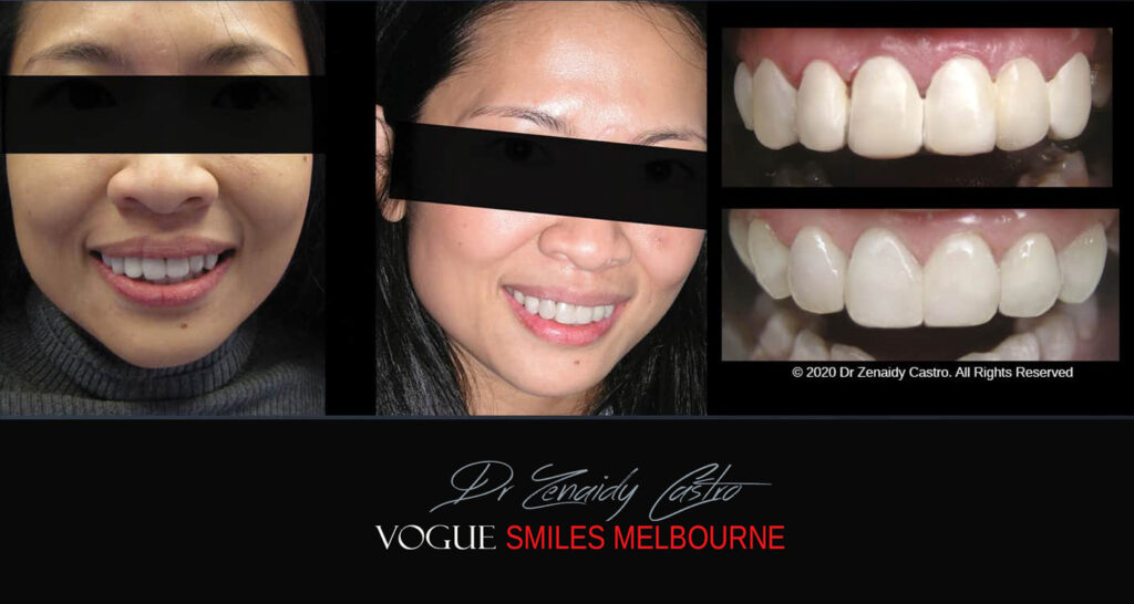 Composite Resin Veneers near Jackson Road Noble Park North - Dental bonding Composite Veneers in Jackson Road Noble Park North