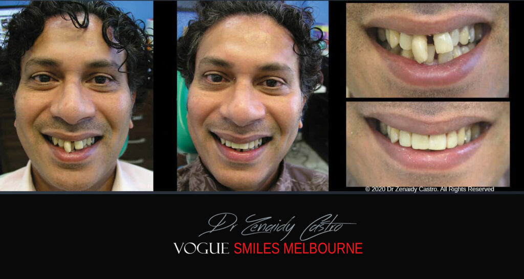 Composite Resin Veneers near Jackson Road Noble Park North - Dental bonding Composite Veneers in Jackson Road Noble Park North
