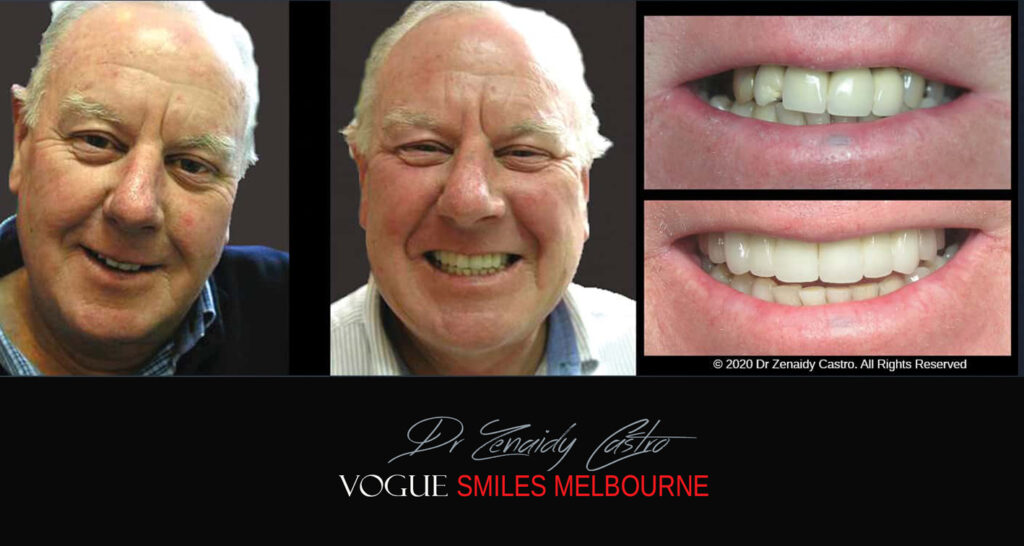 Look younger. Aged Smiles, Anti- Aging Dental Facelift in Noble Park North, Springvale, Dandenong