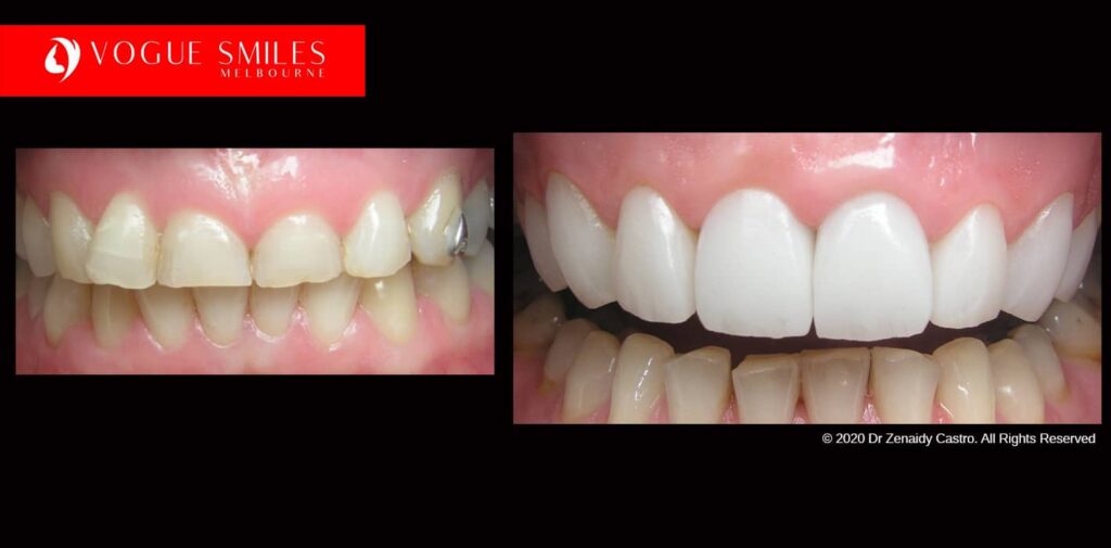 Full-Mouth-Reconstruction-complete-extreme-dental-makeover