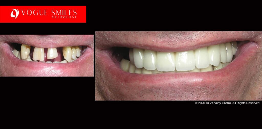 Full-Mouth-Reconstruction-complete-extreme-dental-makeover