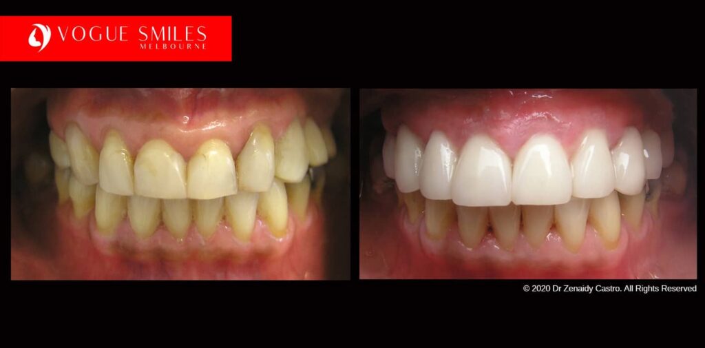 Full-Mouth-Reconstruction-complete-extreme-dental-makeover